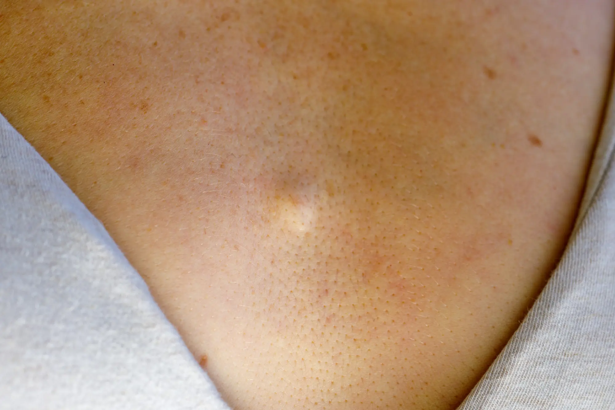 an example of Sebaceous Hyperplasia